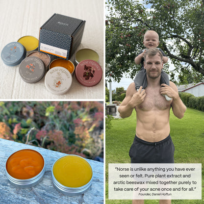 Pimple Scars Balm 2.0